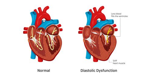 what is the meaning of grade 1 diastolic dysfunction.